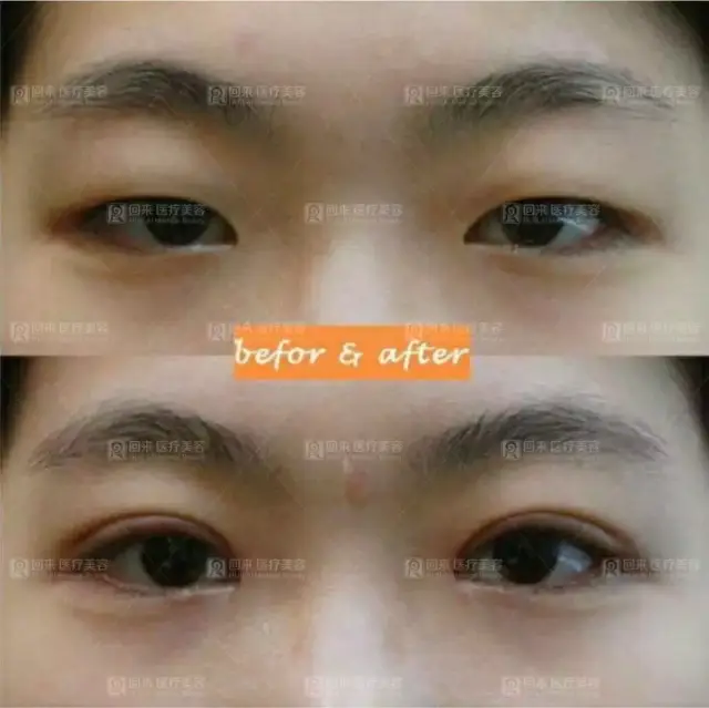 "亚洲眼王"——徐在敦来啦!纯韩技艺,为您打造完美综合媚眼!