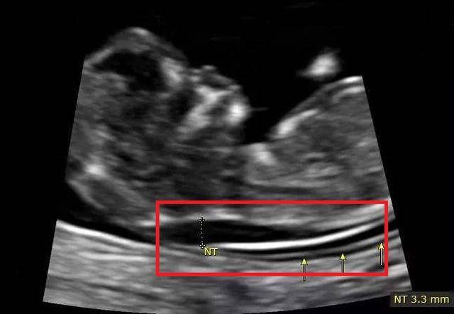 怀孕13周后的一次重要产检结果超过这个数值要当心胎儿畸形了