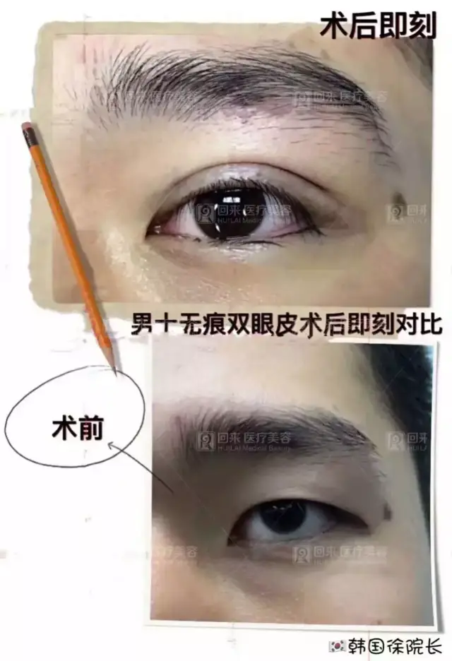 "亚洲眼王"——徐在敦来啦!纯韩技艺,为您打造完美综合媚眼!