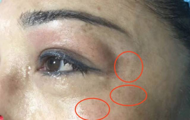 除此之外她眼周还有几处不均匀的泛红,所以羊猜测她这是刚刚做完激光