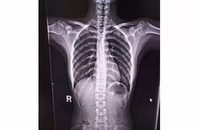 驼背,高低肩,歪脖子,快用这个动作查查有没有脊柱侧弯!