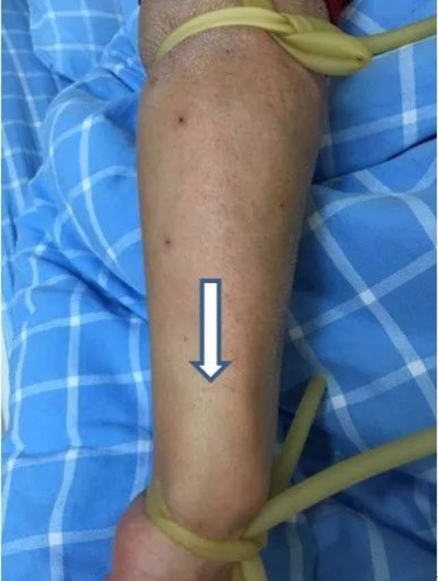 护士护师都必须知道两根压脉带使用方法介绍