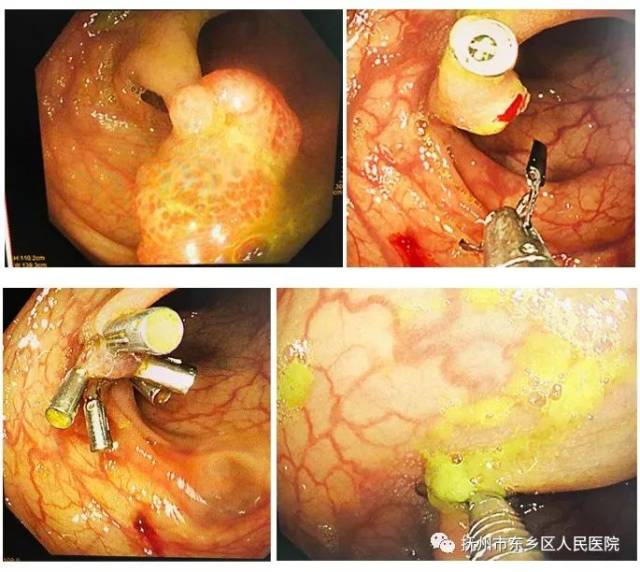 电镜下切除巨大息肉——南昌大学第一附属医院教授来我院示教内镜下电