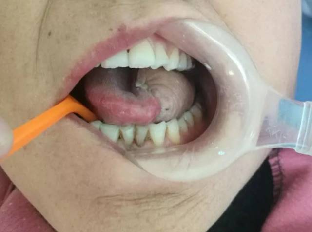 滨州一女士"嫁接"舌头!竟然还成功了!啥情况?