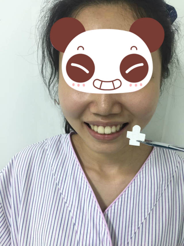 术前拍了照片,当时想是要对比术后的,牙突嘴突···看着自己感觉