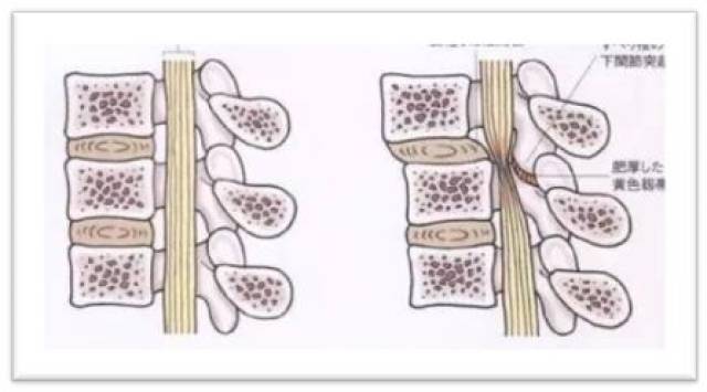 椎管狭窄是怎么造成的图片