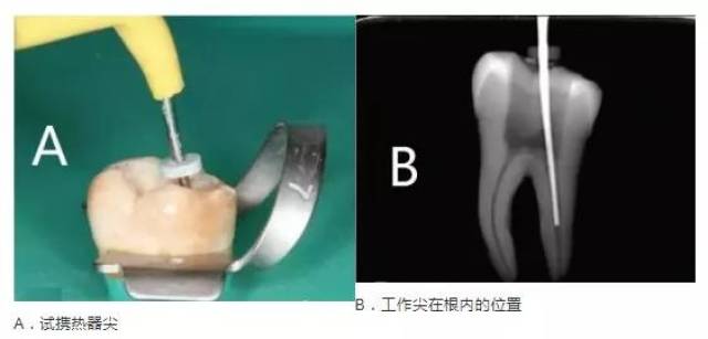 图解：热牙胶充填技术的8个必要操作步骤，你知道吗？_手机搜狐网