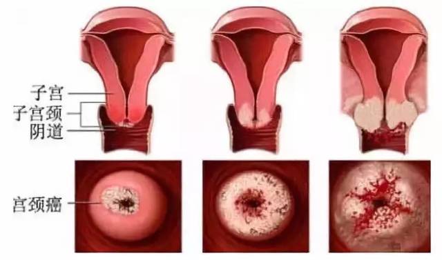 女性人乳瘤病毒长在哪图片