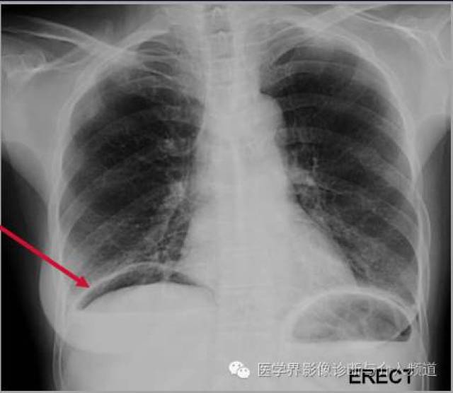 腹腔游离气体ct图像图片