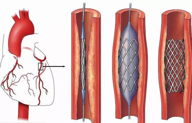 支架屬於內科手術,是微創,不用開刀,通過導管,達到心臟血管.