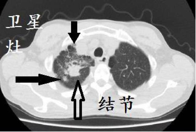 肺结核ct图片图解图片