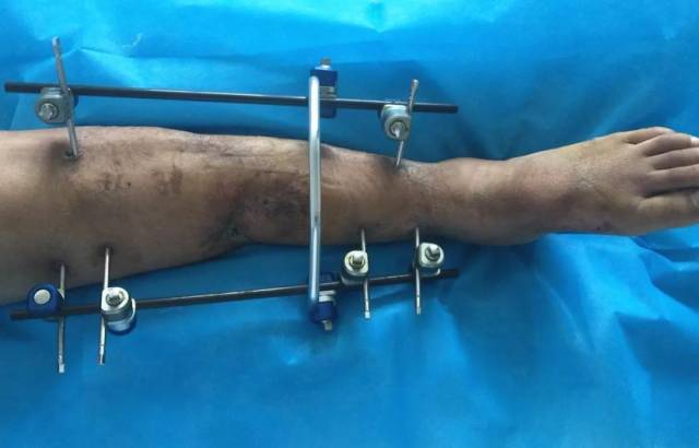 "患者来的时候情况比较严重,面临截肢的可能,诊断为双小腿挤压毁损伤