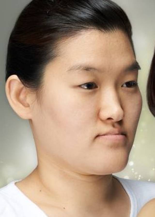 这一组对比图就能发现好几个问题,左边是正常的,右边下巴后缩,双颚