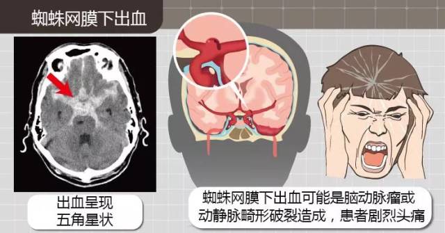 硬脑膜下出血图片