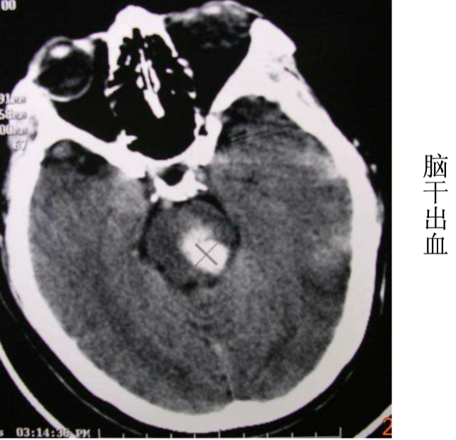 頭顱ct解剖與常見出血梗死判讀