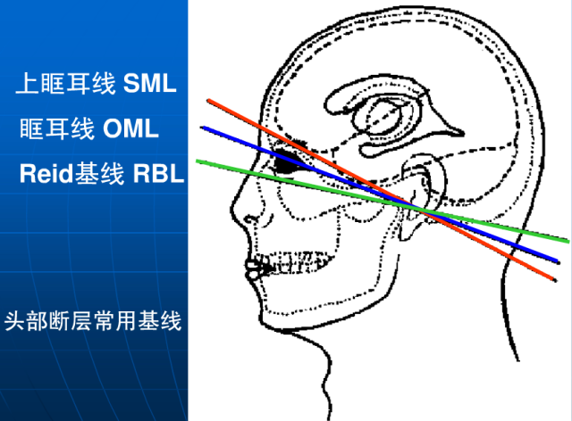 頭顱ct解剖與常見出血梗死判讀