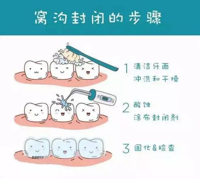 儿童窝沟封闭是针对牙齿发育时候的儿童进行的一种能有效增强牙齿抗龋