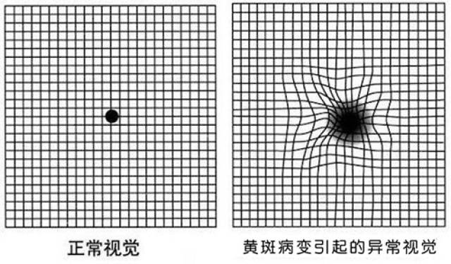 眼睛黄斑病变:看字扭曲,颜色异常