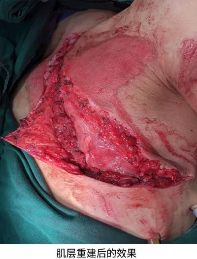 开放性胸外伤,胸壁缺损,左肺破裂……中肿下沉医生5小时"抢"回生命!