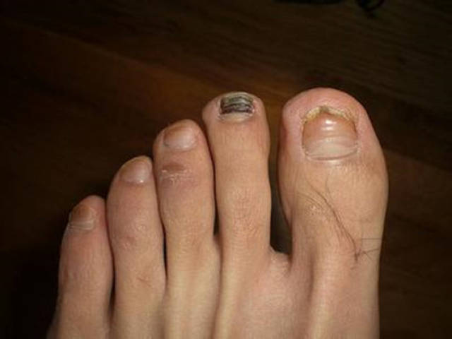 脚指甲竖纹肝癌图片图片