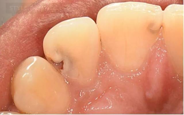 【病例分享】前牙邻面龋的治疗技巧