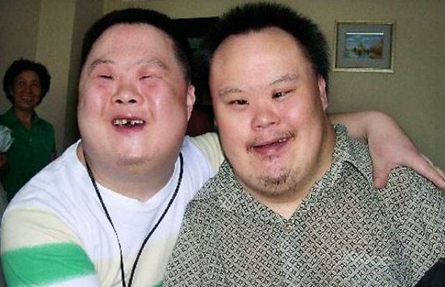 唐氏综合症是一种染色体变异造成的先天性遗传疾病,身患这种病的人