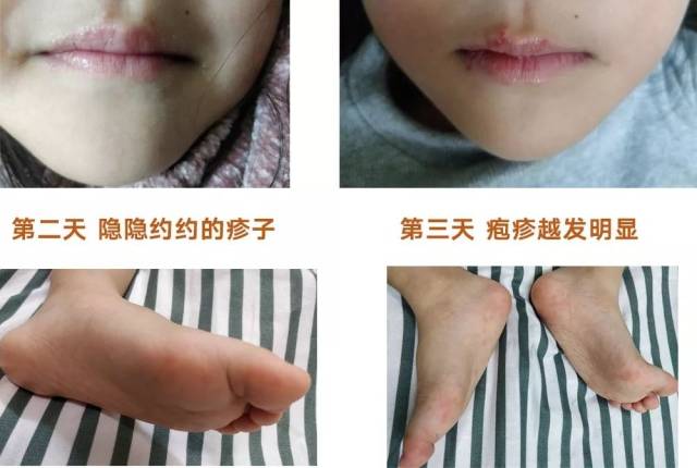 亲历娃从疱疹性咽峡炎到手足口,你想知道的可能都有