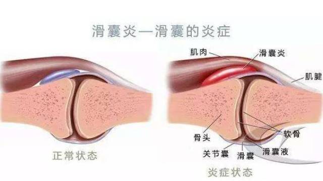 腓肠肌内侧头滑囊炎图片