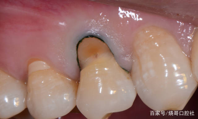 后槽牙做什么嵌体较好如果做3m树脂填充可以吗