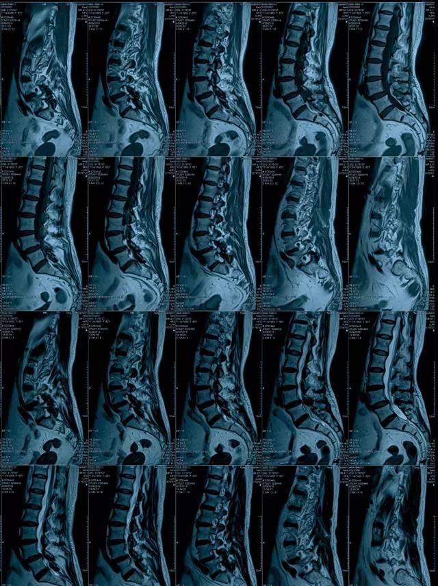 腰椎滑脱x线图片图片