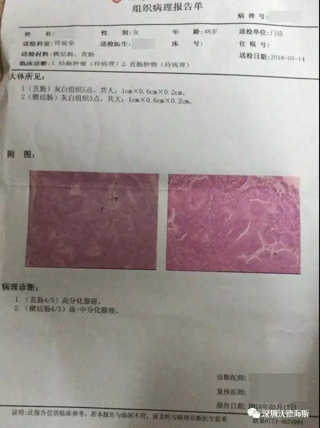 肠癌肠镜报告图片