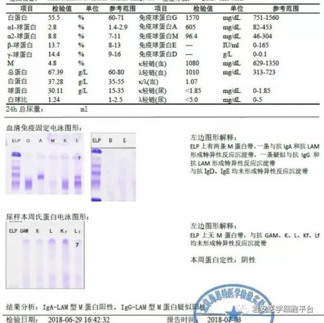 【精品系列】一例意义未明的单克隆免疫球蛋白血症(mgus)的病例分享