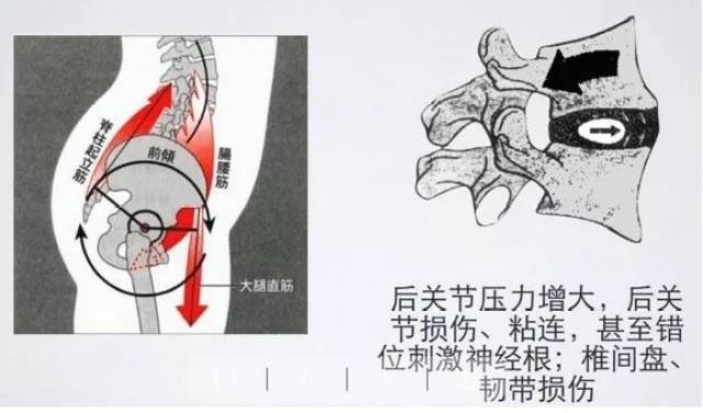 兩個極好的動作糾正骨盆前傾