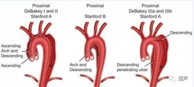 主动脉弓缩窄分型图片图片