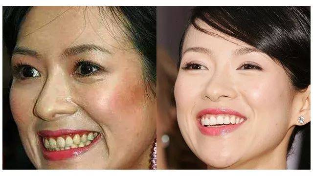 两分钟老黄牙开始变白,老污垢瞬间溶解,连多年的口