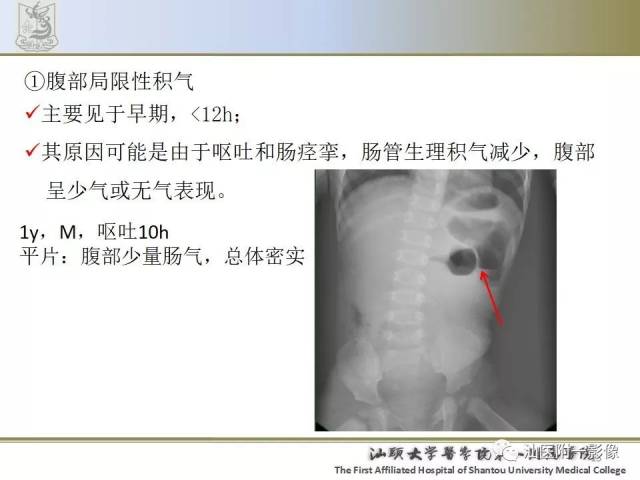 肠套叠图片腹部图片