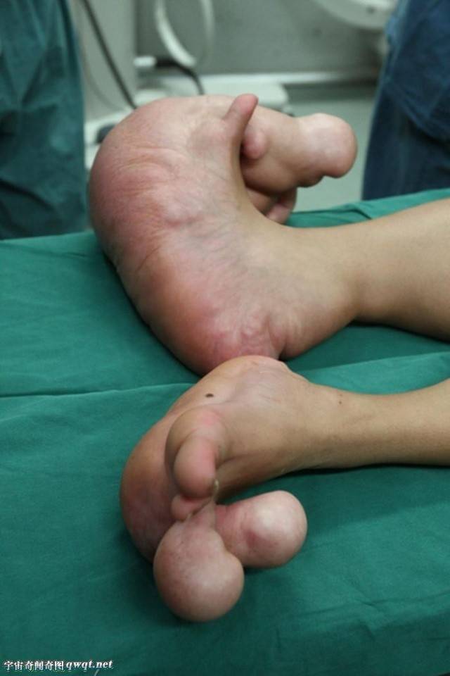 广西瑶族14岁男童患罕见大脚症巨足脚趾大如小腿