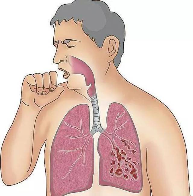 老慢支,慢阻肺患者病情也反反复复 咳嗽声光是听着都觉得肺疼 冬季