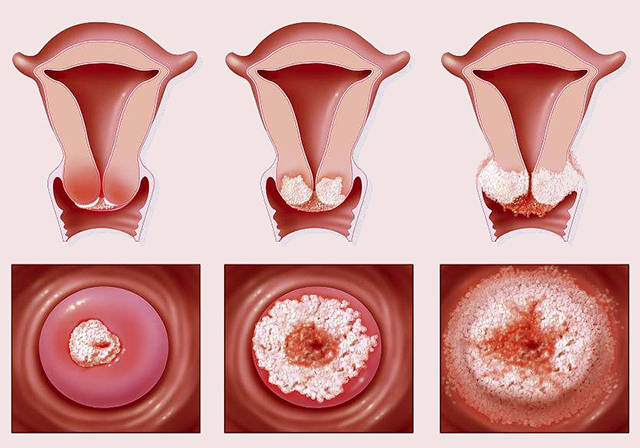 宫颈增生的真实图片图片