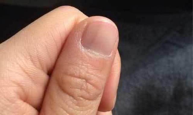 指甲凹陷下去是病吗?指甲长成这几种样子,说明你身体状况不太好