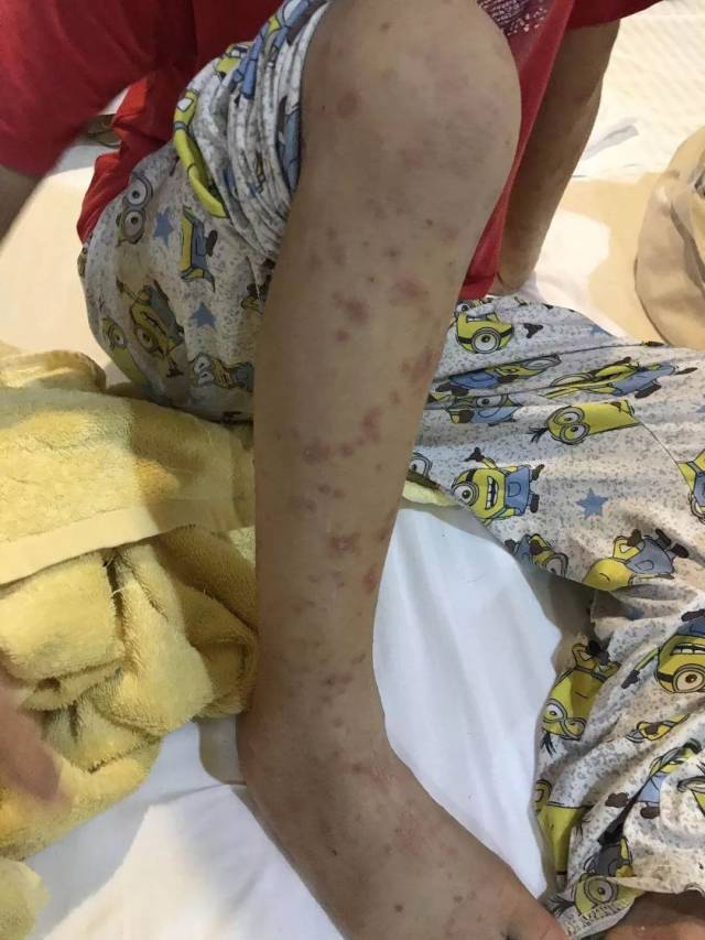 麦友刚副教授介绍道, 多形红斑是一种病因复杂的急性炎症性皮肤病,较