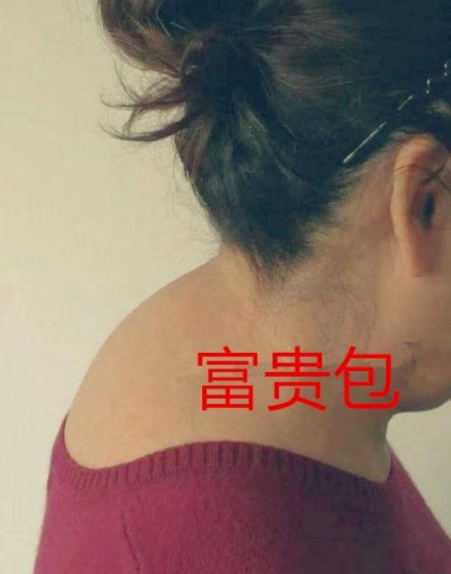也就是在第七颈椎和第一胸椎有凸出的硬包块