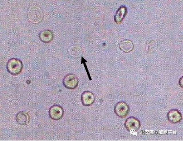 尿沉渣涂片未染色(普通光镜)400 影红细胞 2018303 箭头所指"