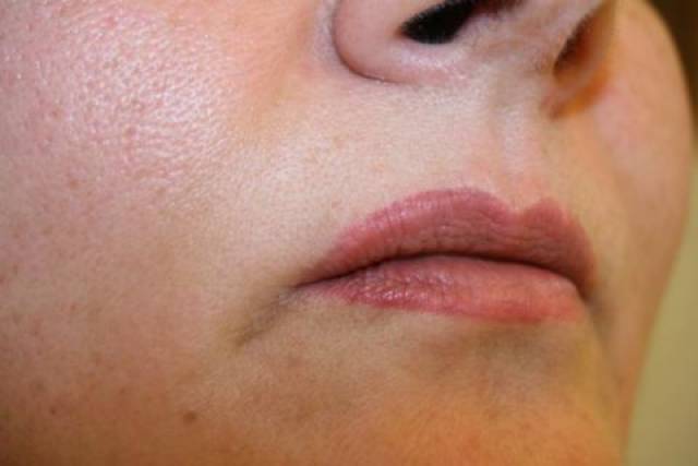 脂溢性角化,咖啡斑,雀斑样痣,老年斑,晒斑 点阵模式 黄褐斑,色素沉着