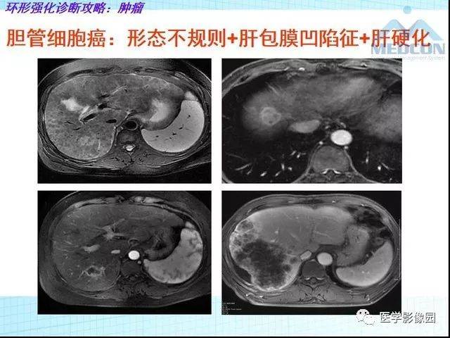 肝臟佔位性病變ct,mri強化特徵 | 影像天地