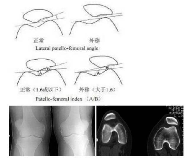 髌骨恐惧试验(patellar apprehension sign)阳性.