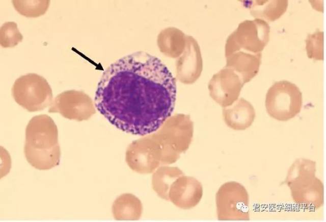 外周血,瑞氏染色 早幼粒细胞/中性中幼粒细胞    20180203 箭头所指
