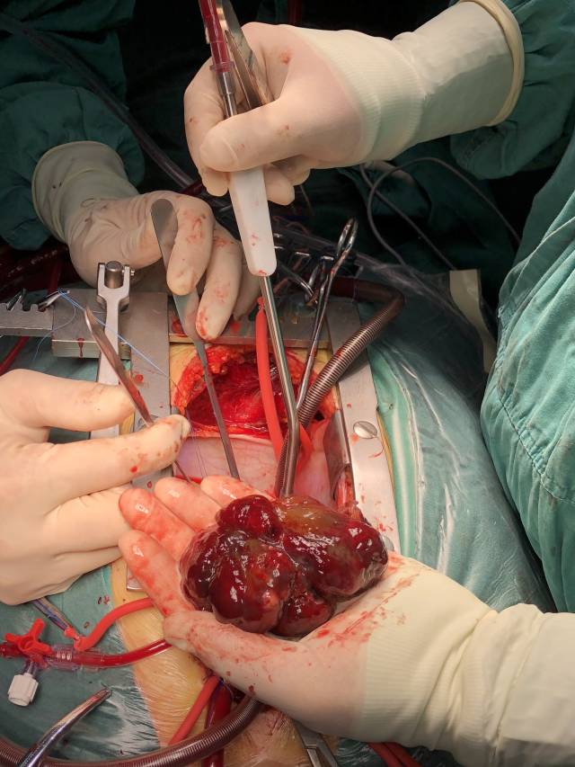 心脏也会长肿瘤,1例巨大右心房黏液瘤