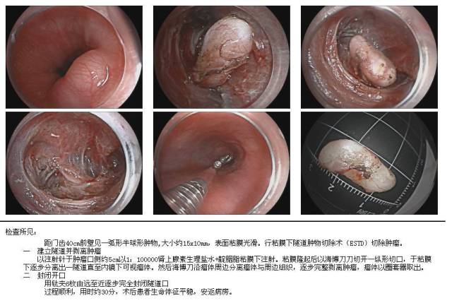 食管粘膜隆起图片