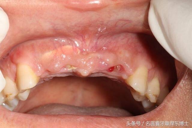 上前牙外伤缺失后的完美再现